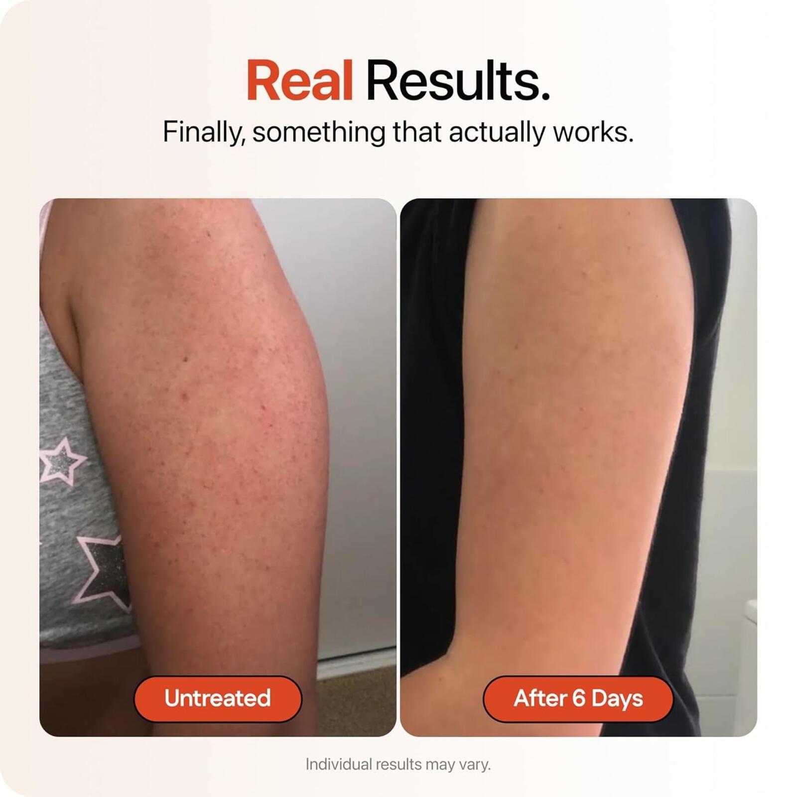 Strawberry Ultra Strength Skin Resurfacing Cream 4oz Triple Acid Complex + B3