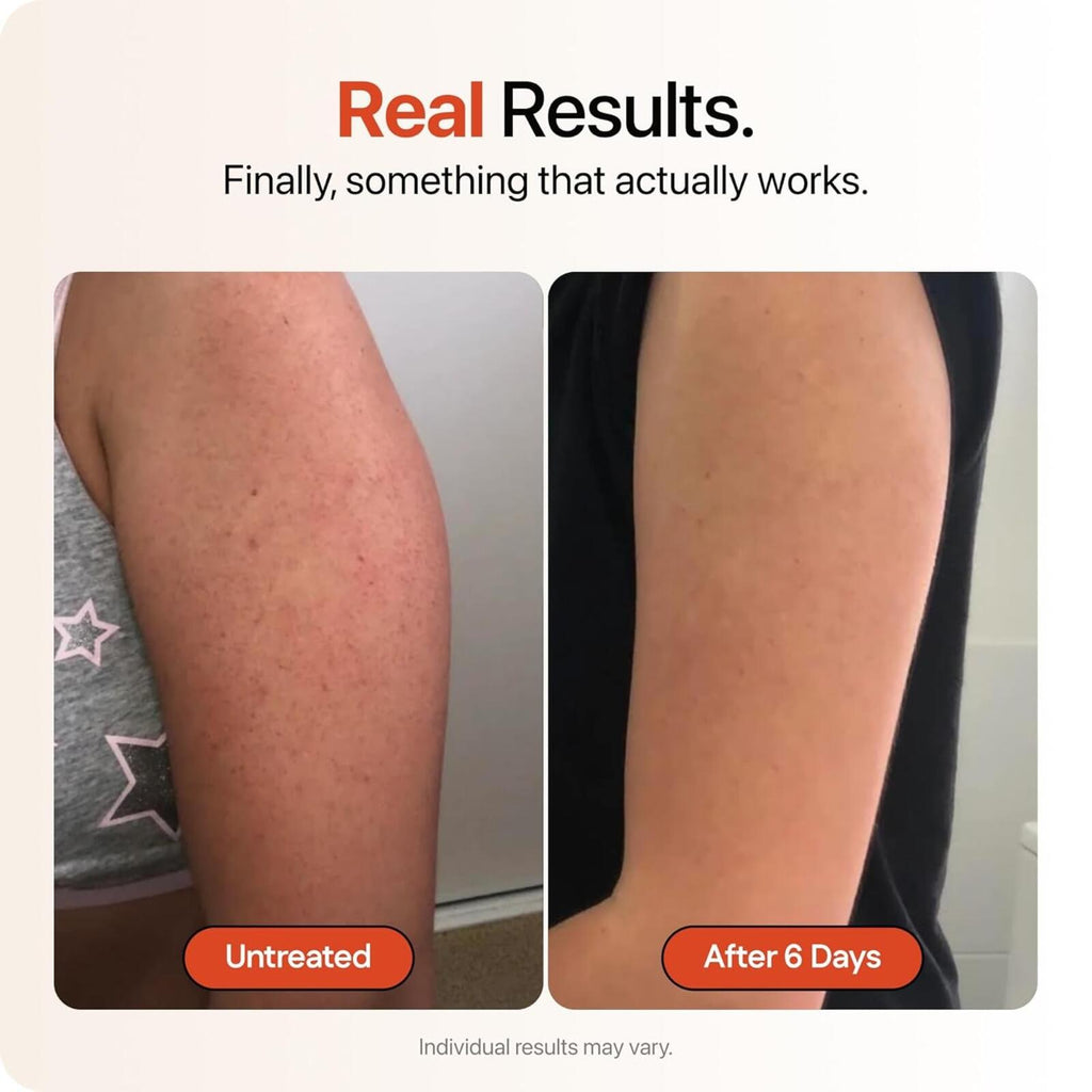 Strawberry Ultra Strength Skin Resurfacing Cream 4oz Triple Acid Complex + B3